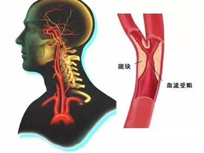 　睡眠和腦卒中