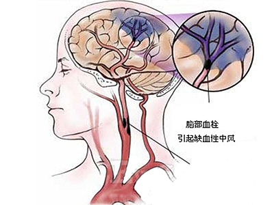 腦出血常見的發病部位都有哪些