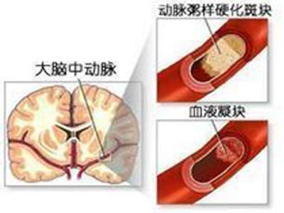 腦出血不同的症狀表現