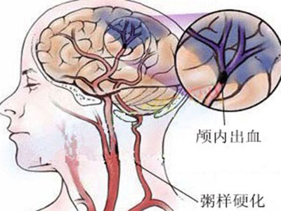 高血壓性腦出血的預防