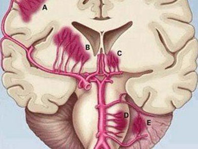 腦出血的類型