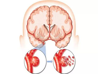 如何確診腦血管硬化病
