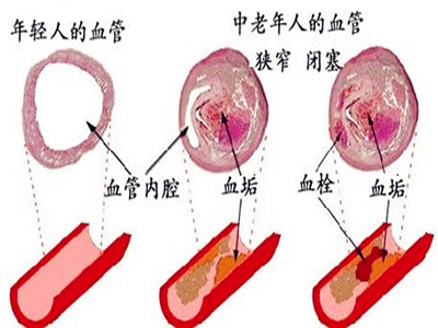 誘發腦血栓形成的情況有哪些