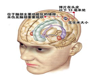 生物細胞治療腦出血怎麼樣