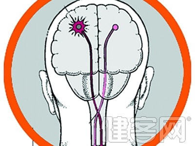 當心腦卒中“逆襲”年輕人