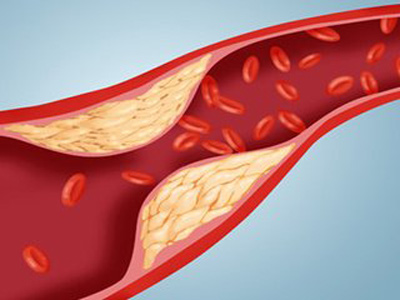 請問動脈硬化的成因是什麽,有何症狀?