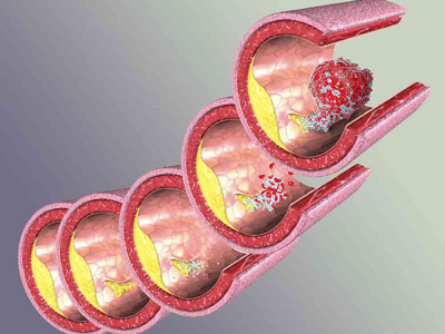 動脈硬化早期檢查 合理飲食可防動脈硬化