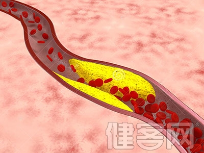動脈硬化有大危害 了解征兆早治療
