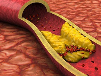 　血脂異常：“健康殺手”正逼近