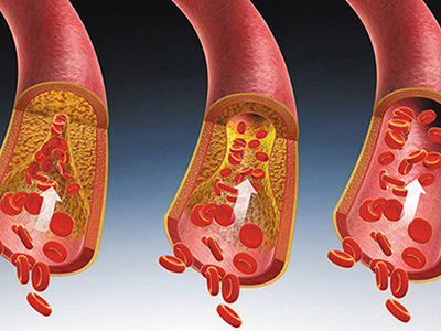 血脂異常不再是中老年人的“專利”