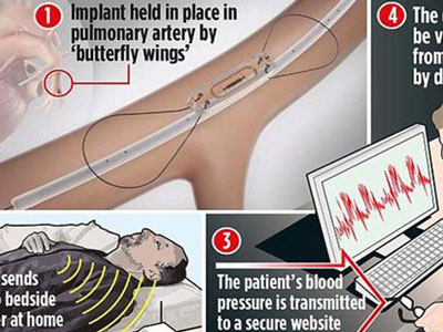 心力衰竭治療可植入預警系統:裝置僅一枚硬幣大