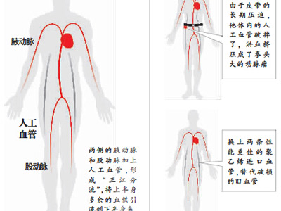 心髒病男子身背兩條人工血管 未穿背帶褲長出動脈瘤