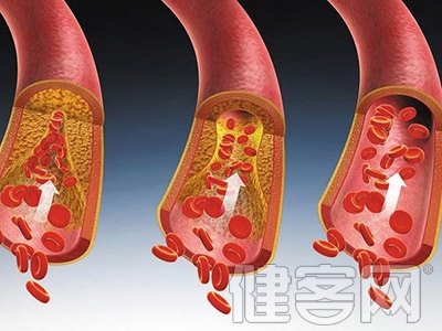 血管健康日：抗“動粥”就是保生命