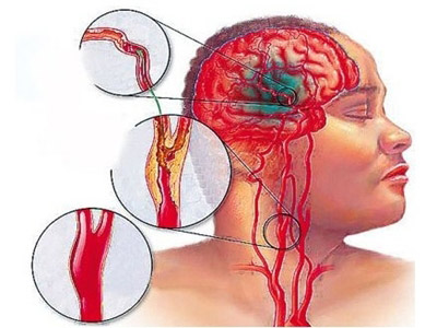 感冒硬扛了一周竟腦梗 醫生：年輕女性容易“中招”