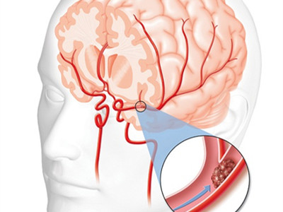 腦血栓有什麼發病前兆？如何避免腦血栓？
