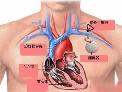認清起搏器治療心律失常四大誤區