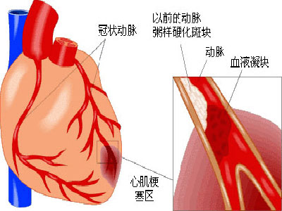 主動脈瓣狹窄的治療原則有哪些