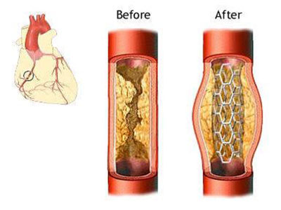 支架術後管理和手術同樣重要