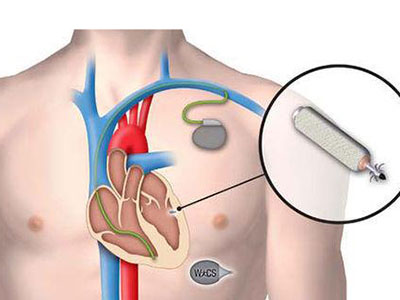 心髒起搏器治療部分心衰！