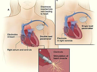 心髒起搏器安裝的常見並發症及處理