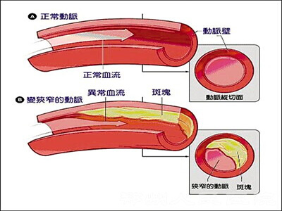 冠狀動脈供血不足的病因診斷！