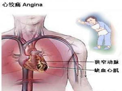 心絞痛與心肌梗塞疼痛的區別！