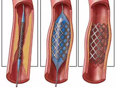 冠心病患者不用裝一輩子支架了