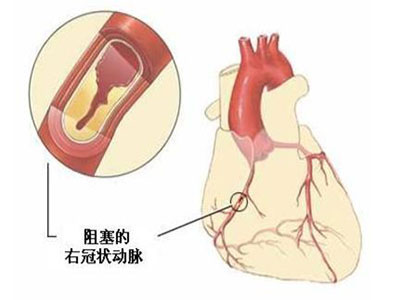 主動脈夾層治療要先分型