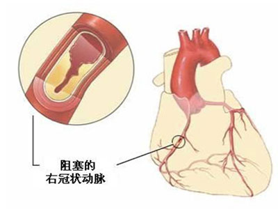 解析急性動脈栓塞的主要症狀