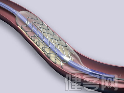 冠狀動脈搭橋手術可保持冠狀動脈暢通