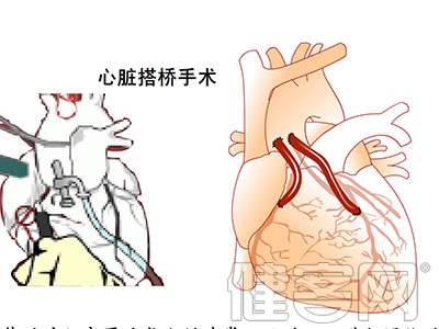 冠脈搭橋術與心髒支架植入的比較