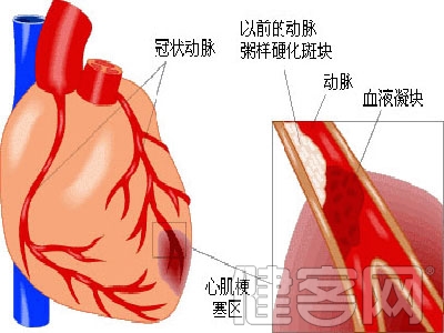 心肌梗塞的治療應選擇搭橋手術麼