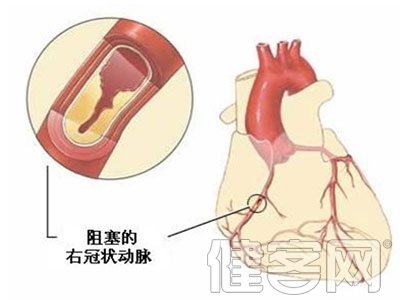 冠脈搭橋術 八個認識