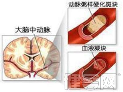 搭橋手術與支架治療那個效果更好