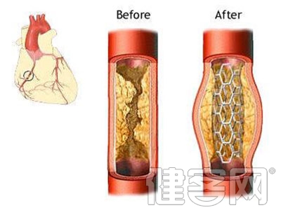 心髒支架手術 其實是這樣的