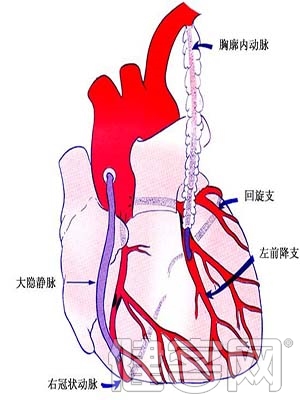 你知道心髒搭橋手術嗎？