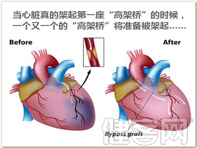 有關冠狀動脈搭橋手術的幾個問題