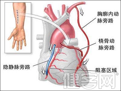 心髒移植-終末期心髒病的唯一選擇