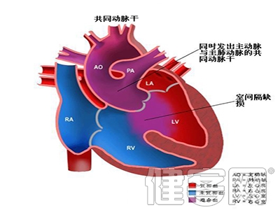 房間隔缺損手術的費用