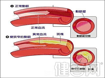 肺動脈瓣狹窄手術治療方法