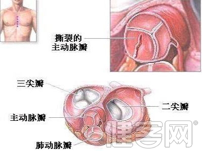 心髒瓣膜手術治療