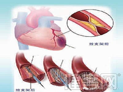 心髒病的手術治療