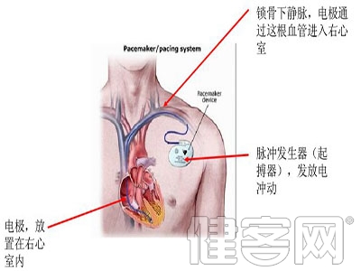 起搏器手術患者使用華法林持續治療可顯著減少血腫風險