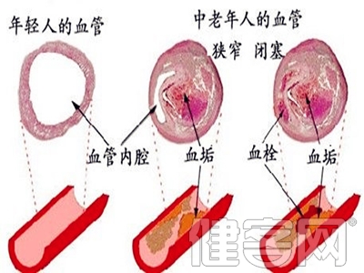 延長血栓預防可降低結直腸癌腹腔鏡手術患者血栓風險