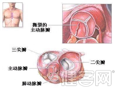 切嗜鉻細胞瘤 換心髒二尖瓣