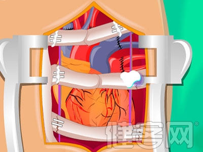 冠脈搭橋 冠心病治療的終極手段