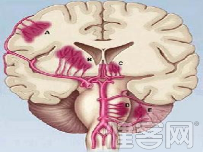 高血壓性腦出血穿刺治療