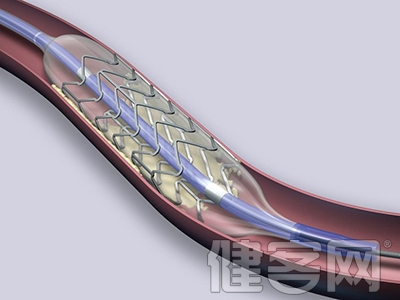 專家：支架手術可緩解症狀但無法解除病因