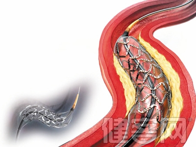 心髒支架 存在濫用現象