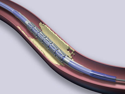 冠心病冠脈支架術的風險如何？